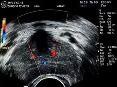 Ultrasound showed inflammatory foci in the prostate