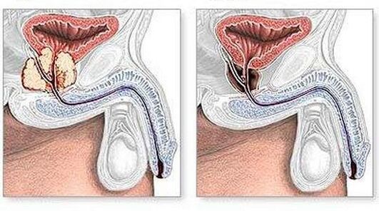 Surgery before and after chronic prostatitis
