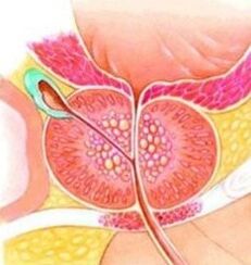 Adenoma prostate
