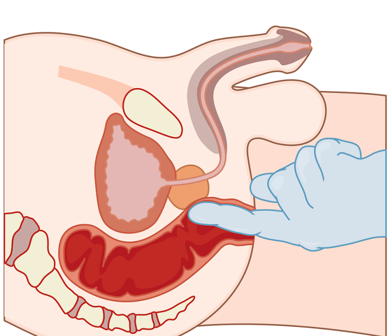 prostate massage in prostatitis