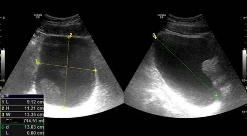 Signs of prostatitis to ultrasound